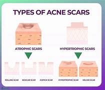 Image result for Atrophic Scar Treatment