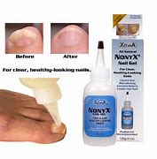 Image result for Keratin Debris Toenails