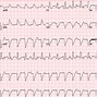 Image result for Myocarditis EKG Finding