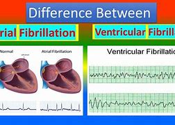 Image result for Ventricular Flutter vs Fib