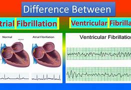 Image result for AFib vs V-fib