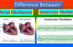 Image result for Ventricular Flutter and Fibrillation