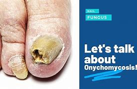 Image result for Toes with Fungus