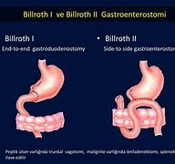 Image result for Billroth I or II