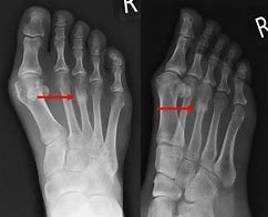 Image result for Stress Fracture Ankle Look a Like