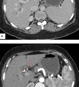 Image result for CT Angiogram Abdomen