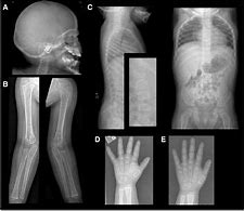 Image result for Lysinuric Protein Intolerance