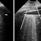 Image result for Pulmonary Regurg Ultrasound Flame