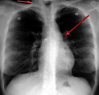 Image result for Asthma Chest X-Ray