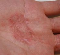 Image result for Eczema On Hands