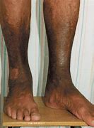 Image result for Skin Darkening Legs