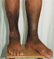 Image result for Thickened Skin On Lower Legs