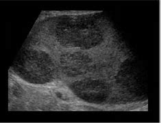 Image result for Spleen Infarction Ultrasound