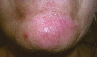 Image result for Scar On Chin