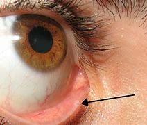 Image result for Punctal Occlusion