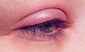 Image result for Stye Symptoms