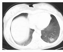 Image result for Right Atrial Thrombus Echocardiogram