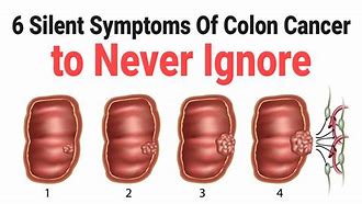 Image result for Colon Cancer Symptoms in Men Signs