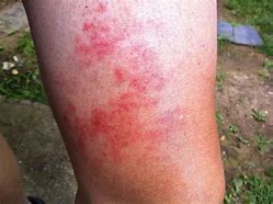 Image result for 10 Common Skin Rashes On Legs