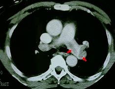 Image result for CTA Chest