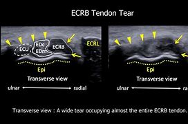 Image result for Common Extensor Tendon Anatomy