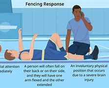 Image result for Fencing Posture Concussion