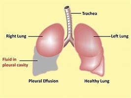 Image result for Pleural Effusion Images