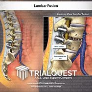 Image result for Lumbosacral Fusion