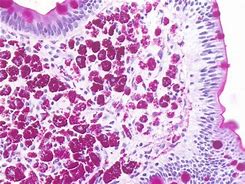 Image result for Whipple Specimen Gross Pathology