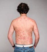 Image result for Candida Rash