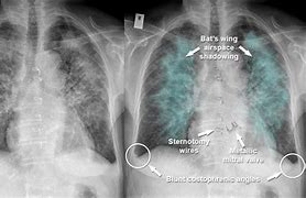 Image result for Acute Pulmonary Oedema and Fluid Overload