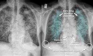 Image result for Acute Pulmonary Oedema Positioning