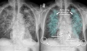 Image result for Acute Lung Oedema