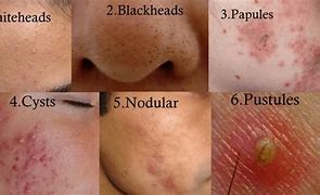 Image result for Pustules and Inflammatory Acne