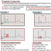 Image result for Pericarditis EKG Findings Example