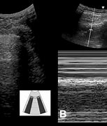 Image result for Lung Ultrasound Probe