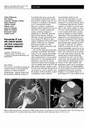 Image result for Pulmonary Embolism Post-Mortem Changes