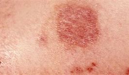 Image result for Spider Rash