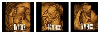 Image result for 4D Ultrasound at 15 Weeks