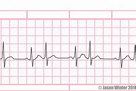 Image result for Bigeminy PVC ECG