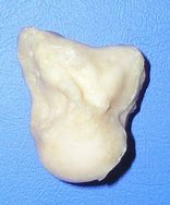 Image result for Capitate Bone Enlarged