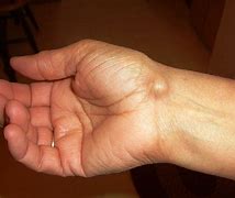 Image result for Cyst On Wrist