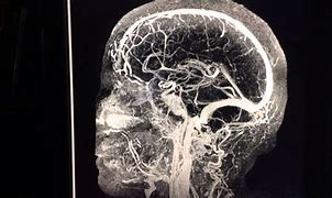 Image result for MRI Angiography