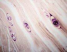 Image result for Trichinosis Parasite