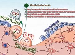 Image result for What Is Bisphosphonates Medication