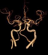 Image result for CT Angiogram Brain Anatomy