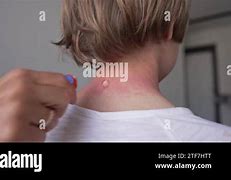 Image result for Allergic Reaction with Pustules