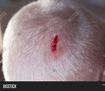 Image result for Skin Laceration Down to the Dermis