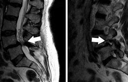 Image result for Lumbar Spine MRI 8Mm