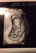 Image result for 4D Ultrasound at 15 Weeks